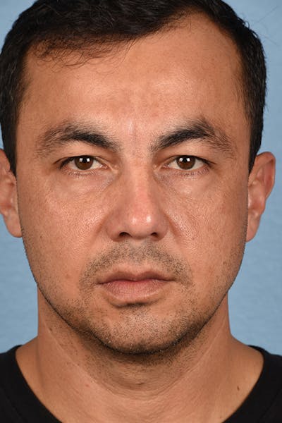 Blepharoplasty Before & After Gallery - Patient 167971 - Image 1