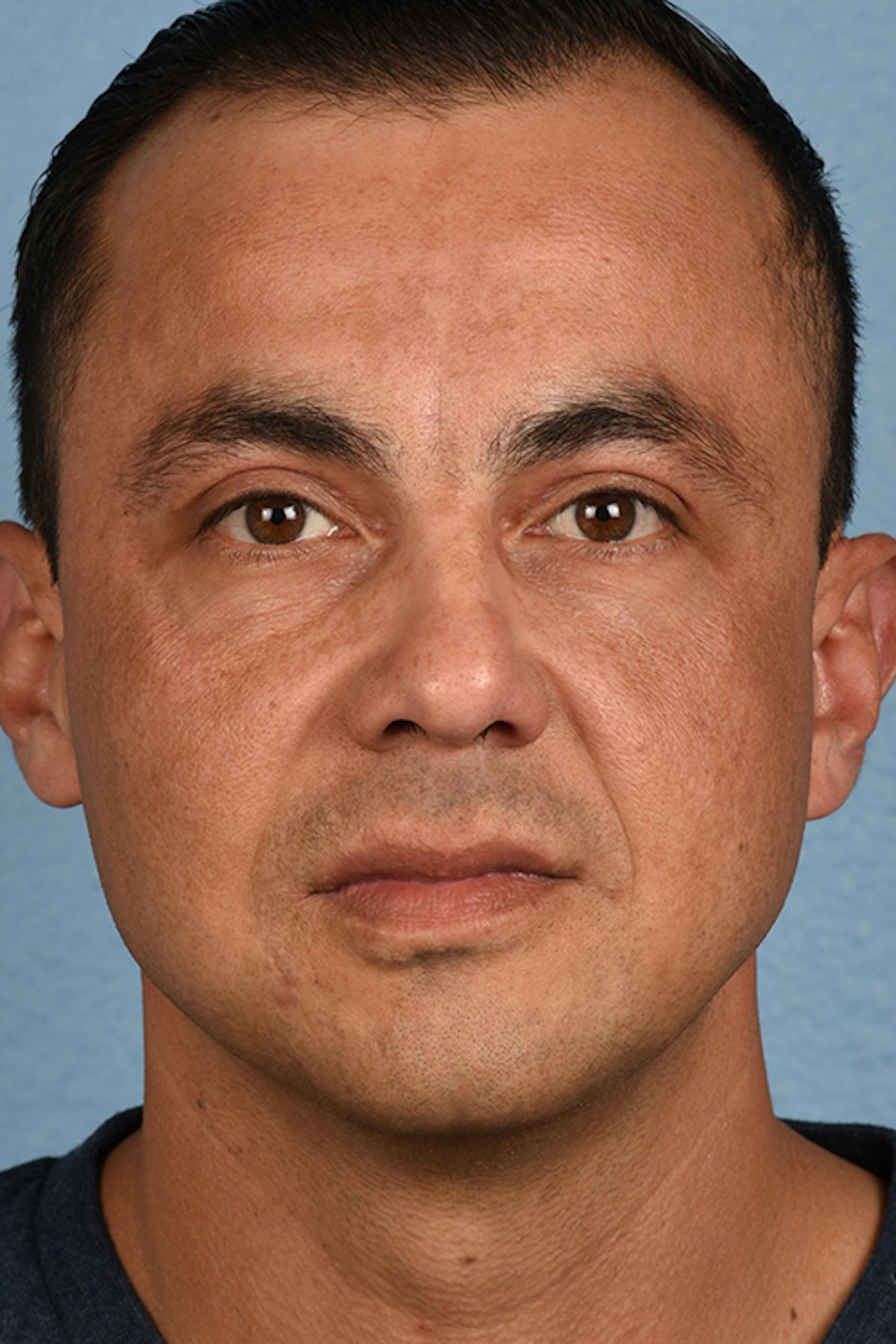 Blepharoplasty Before & After Gallery - Patient 167971 - Image 2