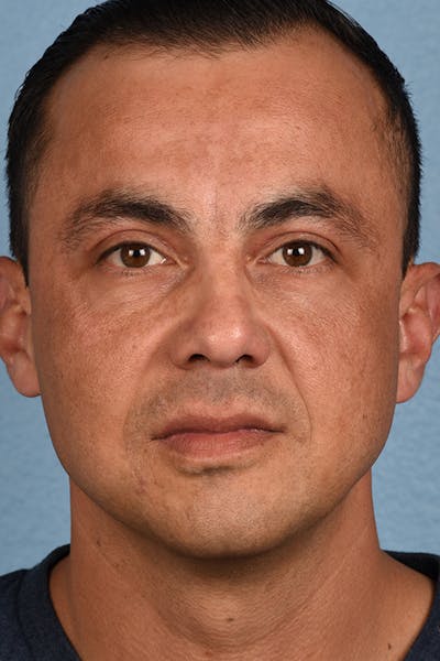 Blepharoplasty Before & After Gallery - Patient 167971 - Image 2
