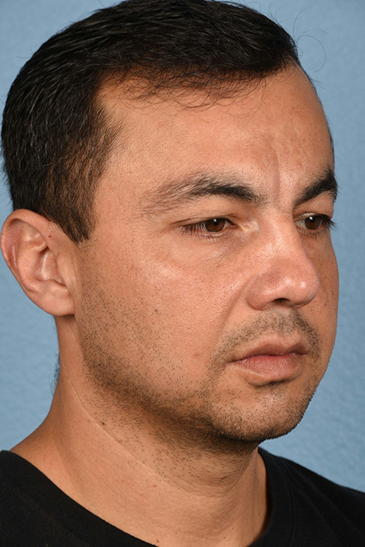 Blepharoplasty Before & After Gallery - Patient 167971 - Image 3