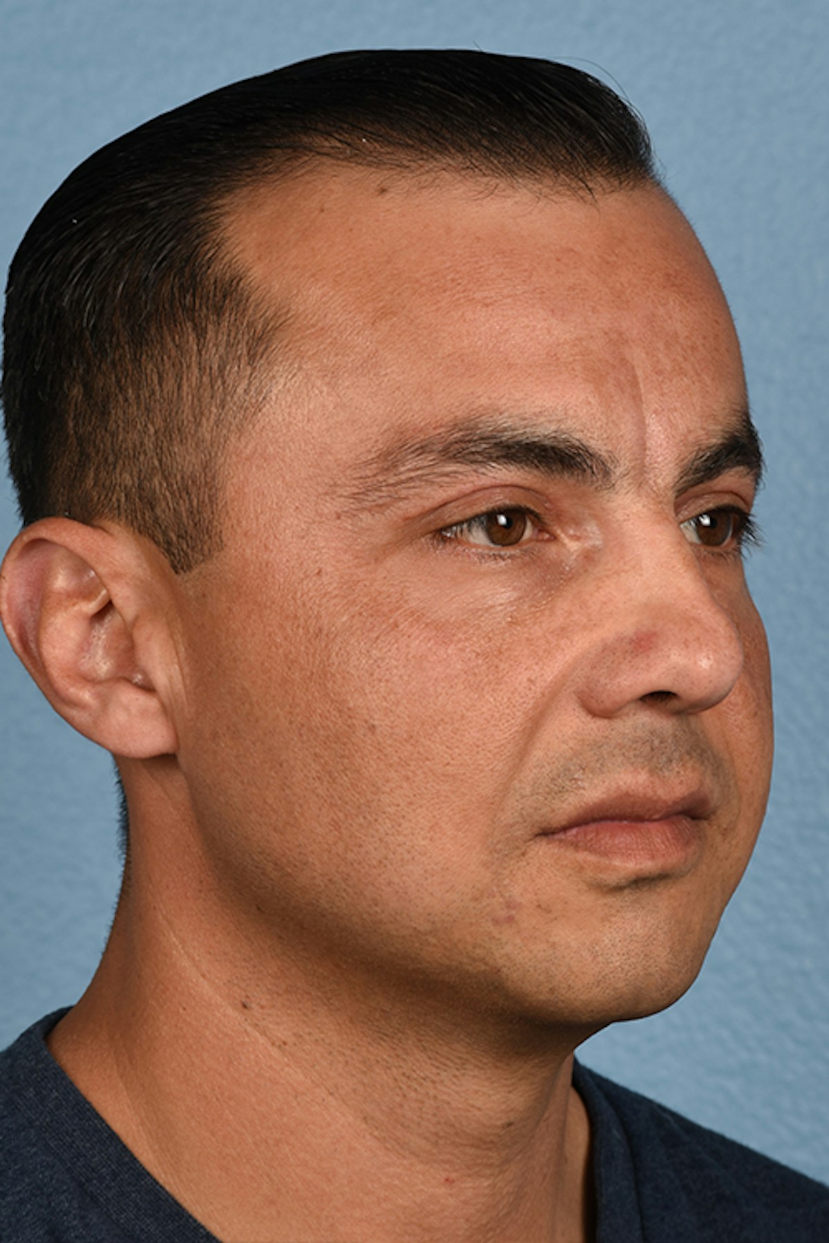 Blepharoplasty Before & After Gallery - Patient 167971 - Image 4