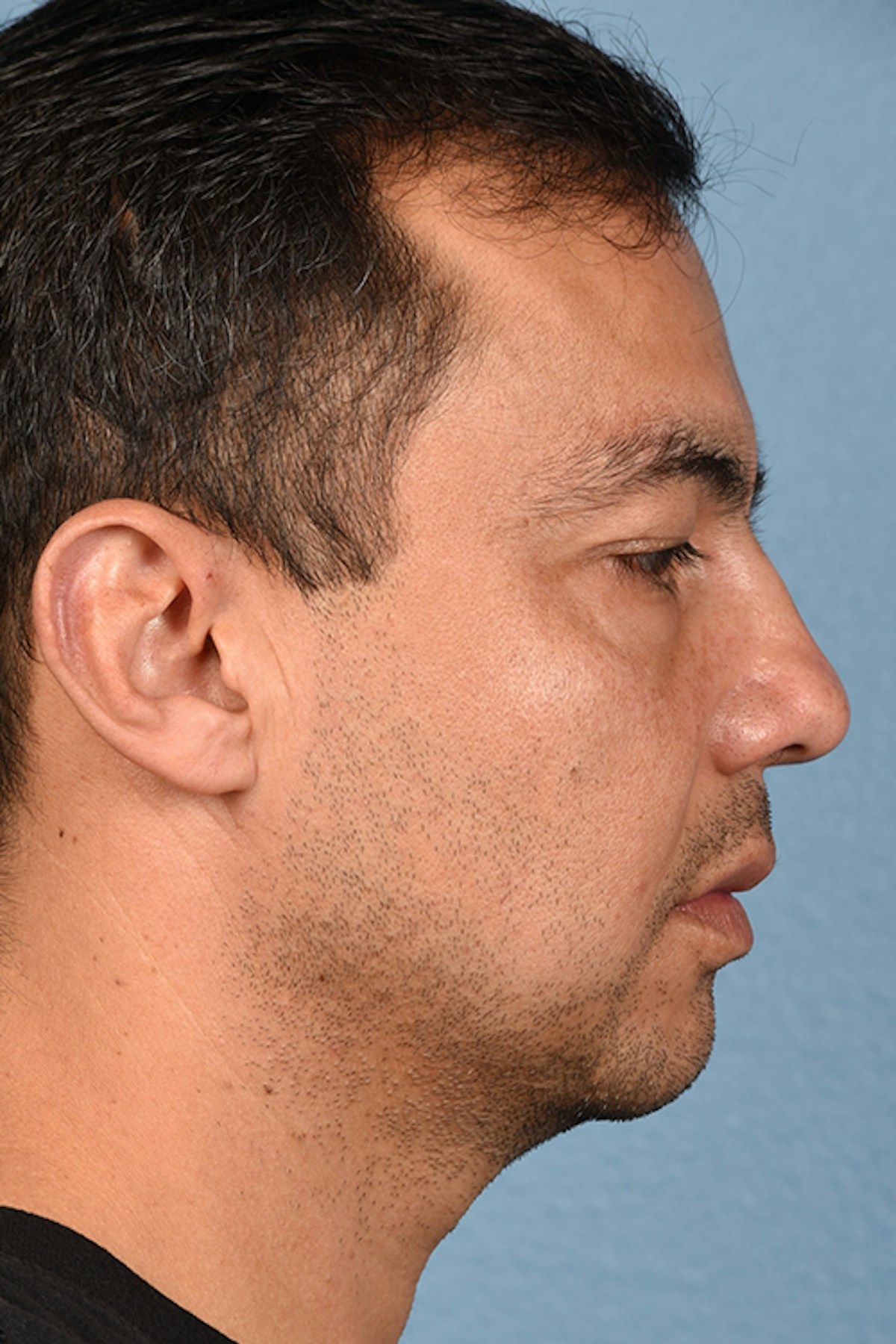 Blepharoplasty Before & After Gallery - Patient 167971 - Image 5