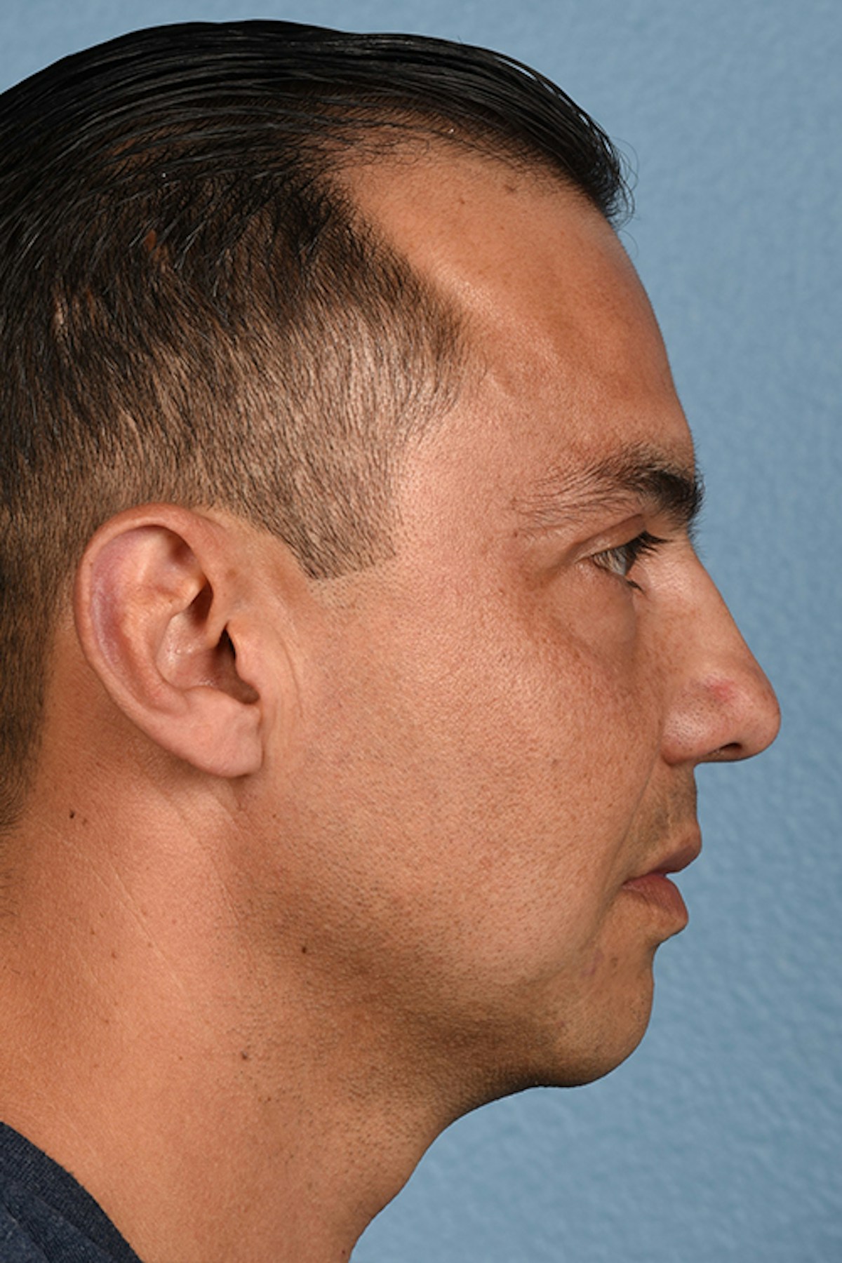Blepharoplasty Before & After Gallery - Patient 167971 - Image 6