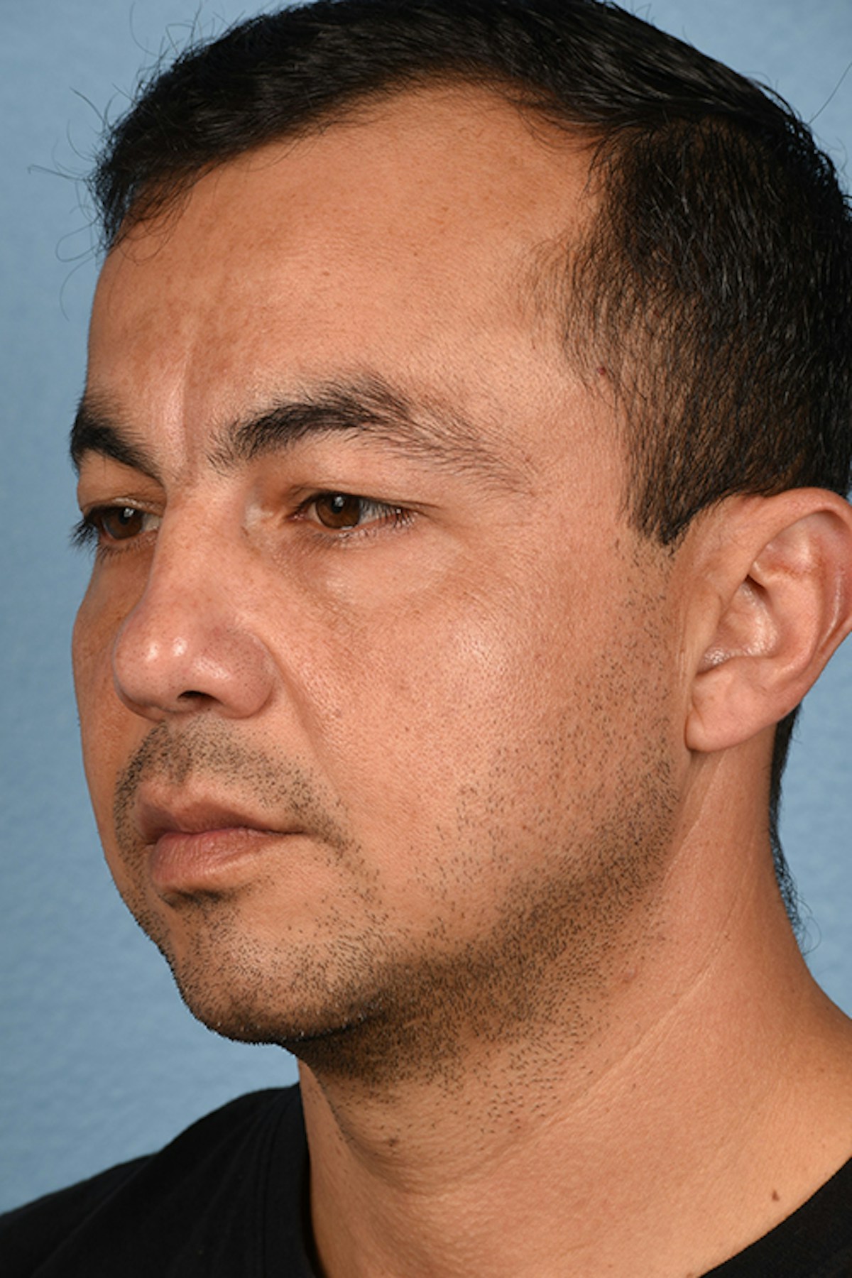 Blepharoplasty Before & After Gallery - Patient 167971 - Image 7