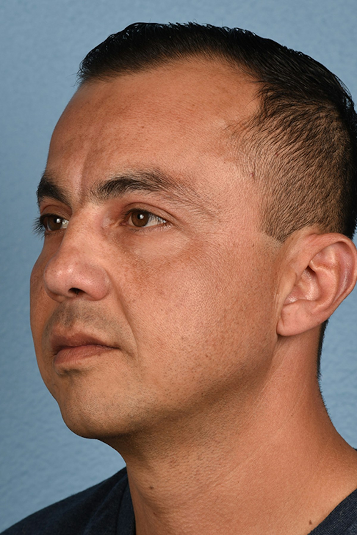 Blepharoplasty Before & After Gallery - Patient 167971 - Image 8