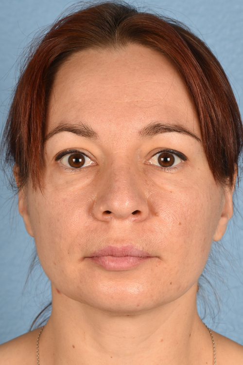 Hidden Patients Before & After Gallery - Patient 363424 - Image 1