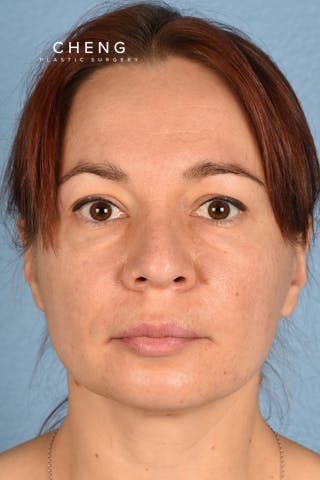 Hidden Patients Before & After Gallery - Patient 363424 - Image 1