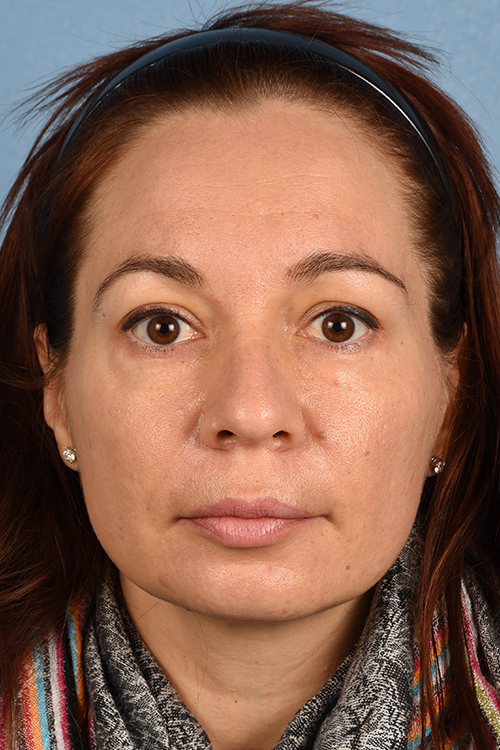 Hidden Patients Before & After Gallery - Patient 363424 - Image 2