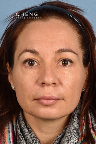 Hidden Patients Before & After Gallery - Patient 363424 - Image 2