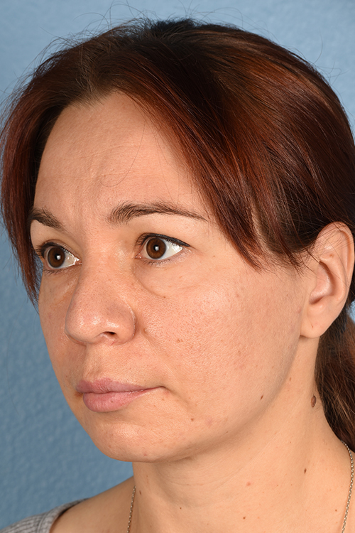 Hidden Patients Before & After Gallery - Patient 363424 - Image 3