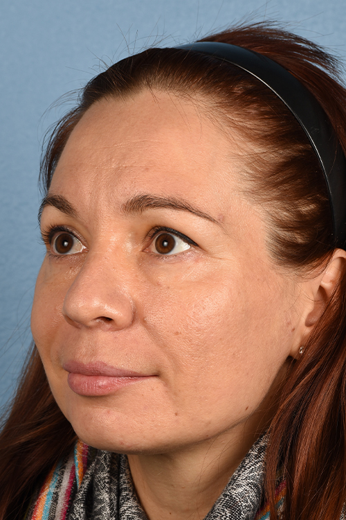 Hidden Patients Before & After Gallery - Patient 363424 - Image 4