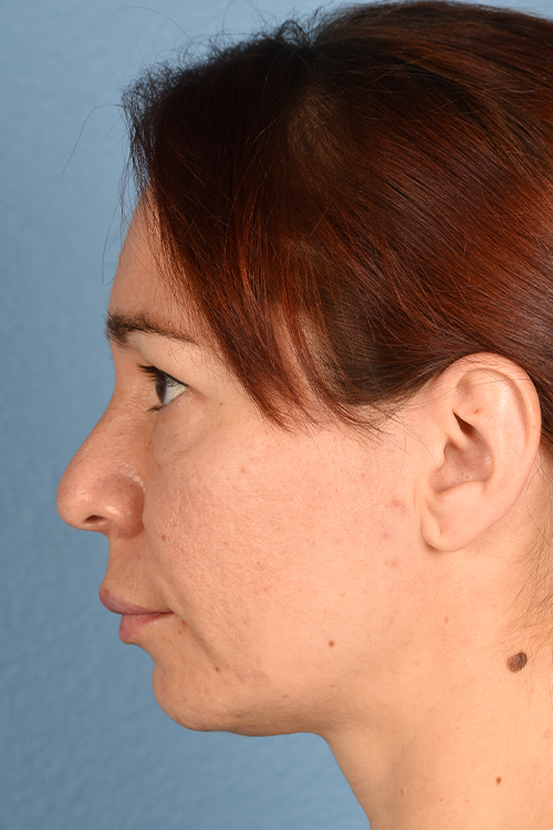 Hidden Patients Before & After Gallery - Patient 363424 - Image 5