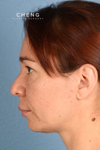 Hidden Patients Before & After Gallery - Patient 363424 - Image 5