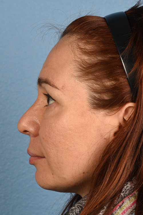 Hidden Patients Before & After Gallery - Patient 363424 - Image 6