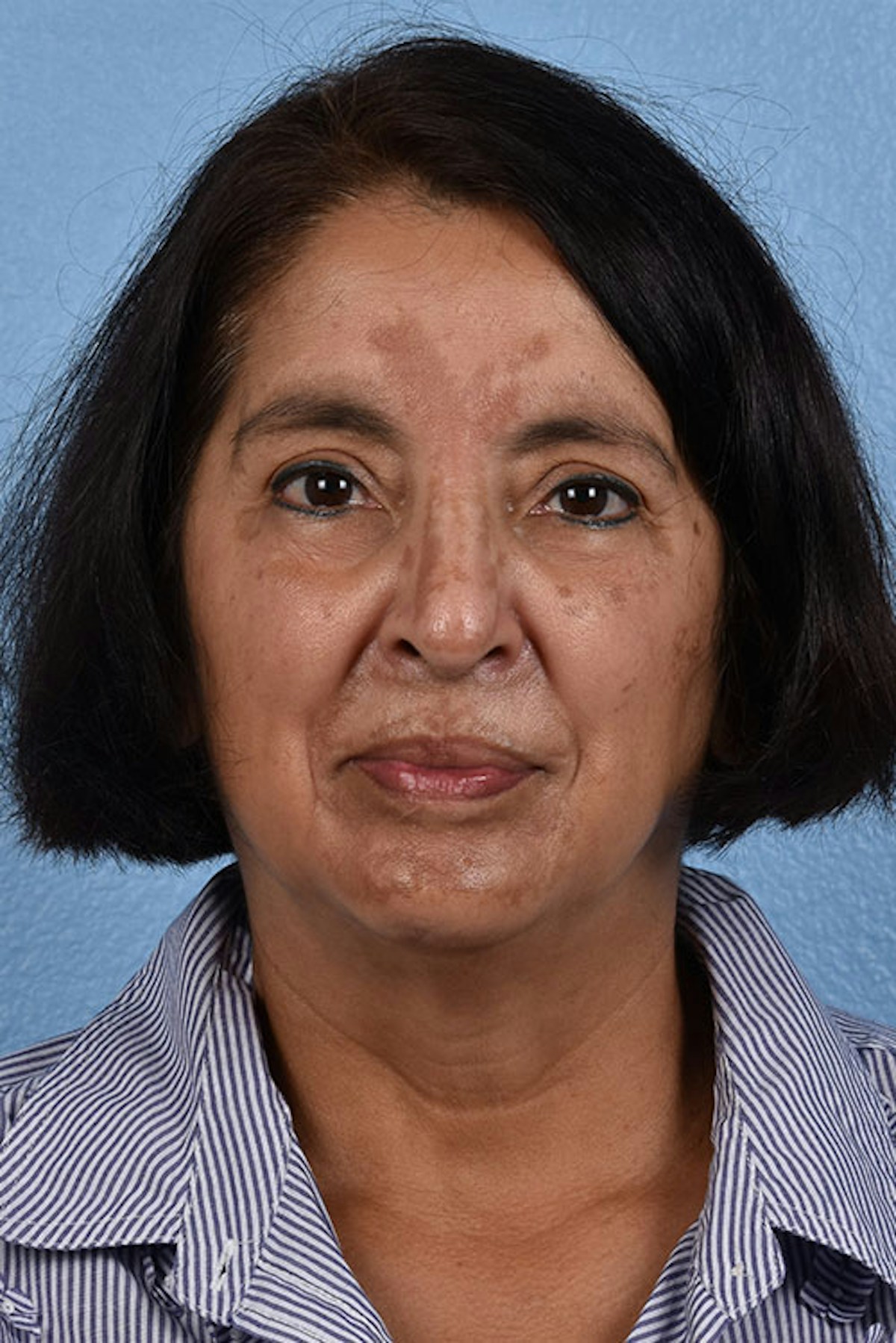 Pigment Laser Before & After Gallery - Patient 210761 - Image 1
