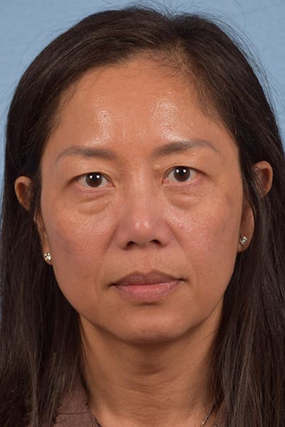 Blepharoplasty Before & After Gallery - Patient 284163 - Image 1