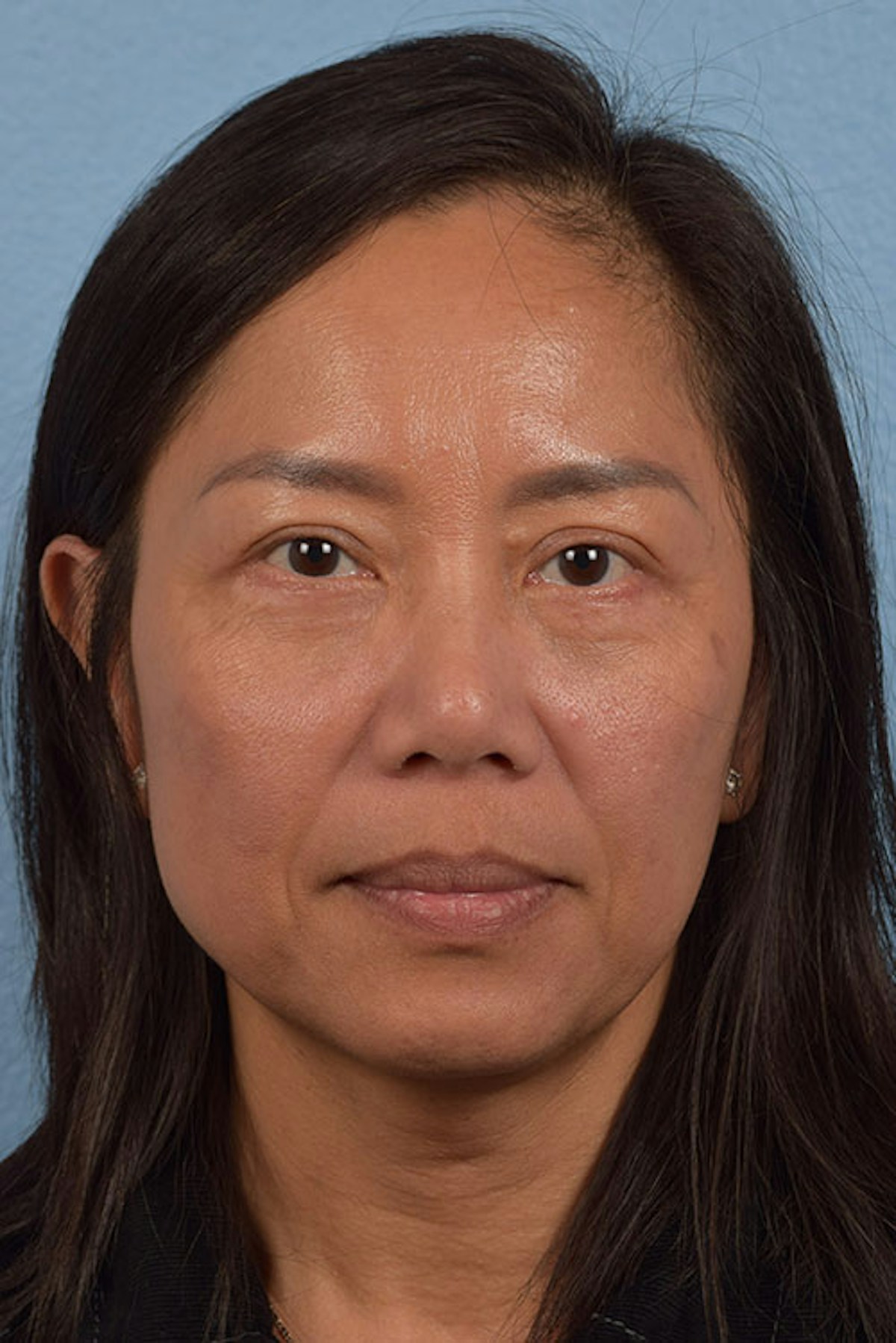 Blepharoplasty Before & After Gallery - Patient 284163 - Image 2