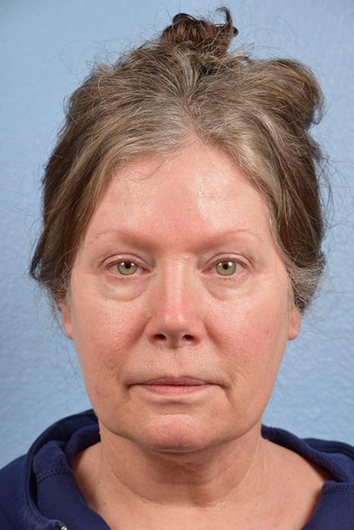 Blepharoplasty Before & After Gallery - Patient 362822 - Image 1