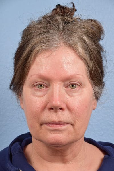 Blepharoplasty Before & After Gallery - Patient 362822 - Image 1