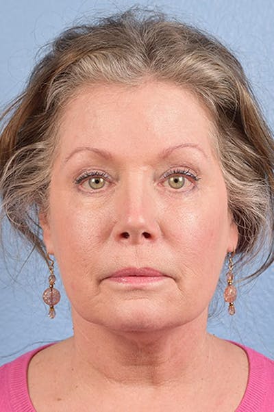 Blepharoplasty Before & After Gallery - Patient 362822 - Image 2