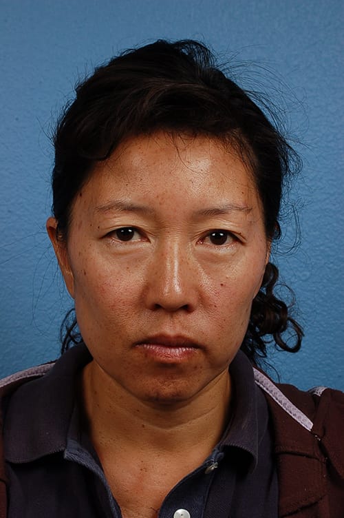 Hidden Patients Before & After Gallery - Patient 767922 - Image 1