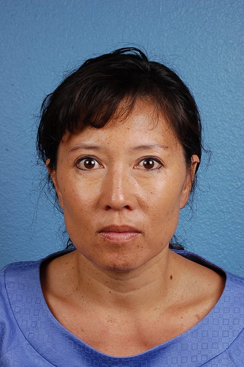 Hidden Patients Before & After Gallery - Patient 767922 - Image 2