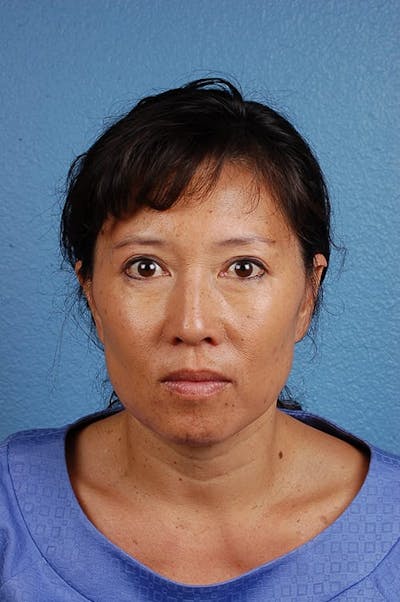 Hidden Patients Before & After Gallery - Patient 767922 - Image 2