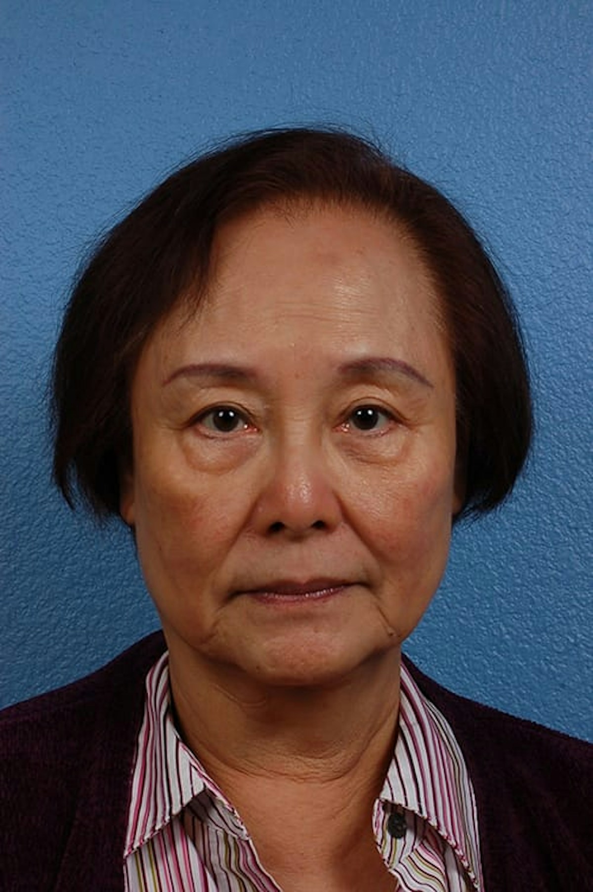 Blepharoplasty Before & After Gallery - Patient 181630 - Image 1