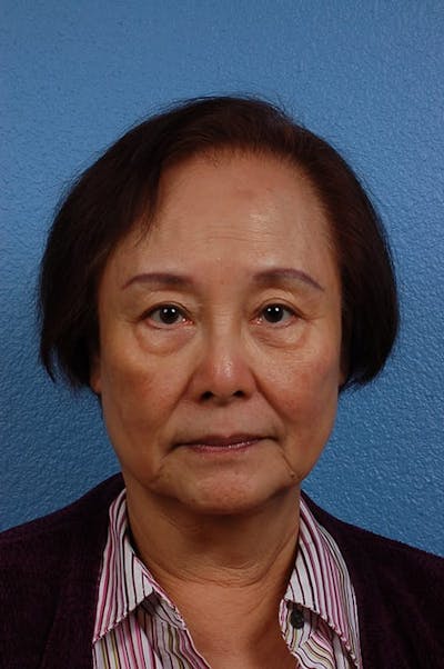 Blepharoplasty Before & After Gallery - Patient 181630 - Image 1