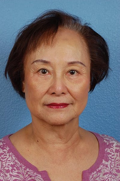 Blepharoplasty Before & After Gallery - Patient 181630 - Image 2