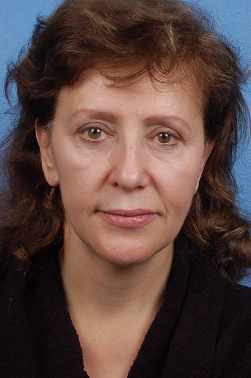 Brow Lift Before & After Gallery - Patient 419519 - Image 1