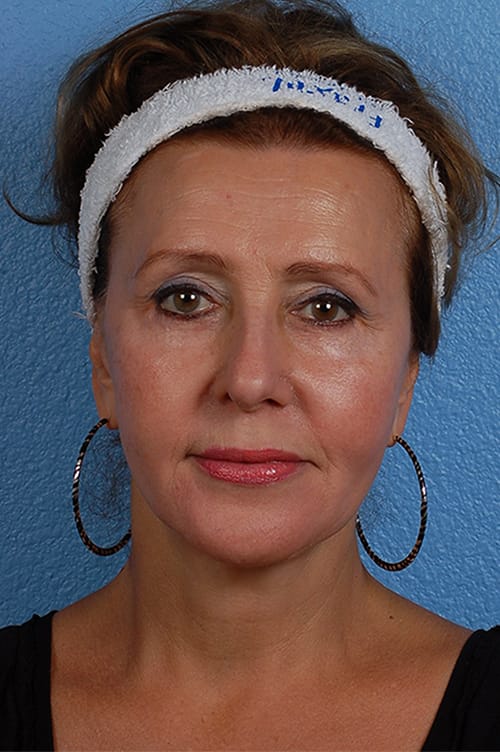 Hidden Patients Before & After Gallery - Patient 133964 - Image 2