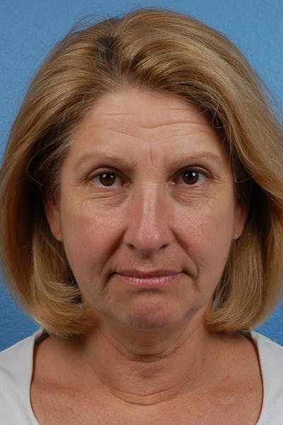Blepharoplasty Before & After Gallery - Patient 177584 - Image 1
