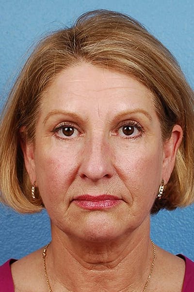 Blepharoplasty Before & After Gallery - Patient 177584 - Image 2