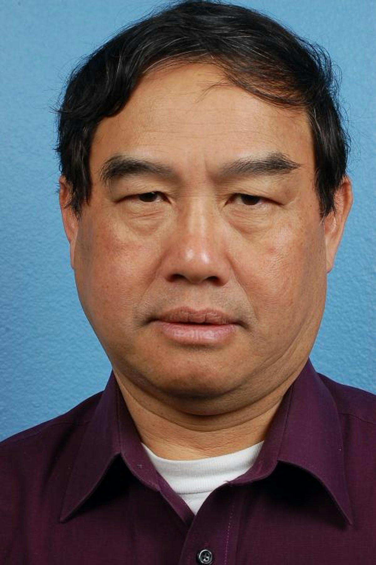 Blepharoplasty Before & After Gallery - Patient 232957 - Image 1
