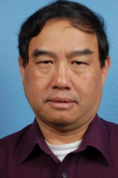 Blepharoplasty Before & After Gallery - Patient 232957 - Image 1