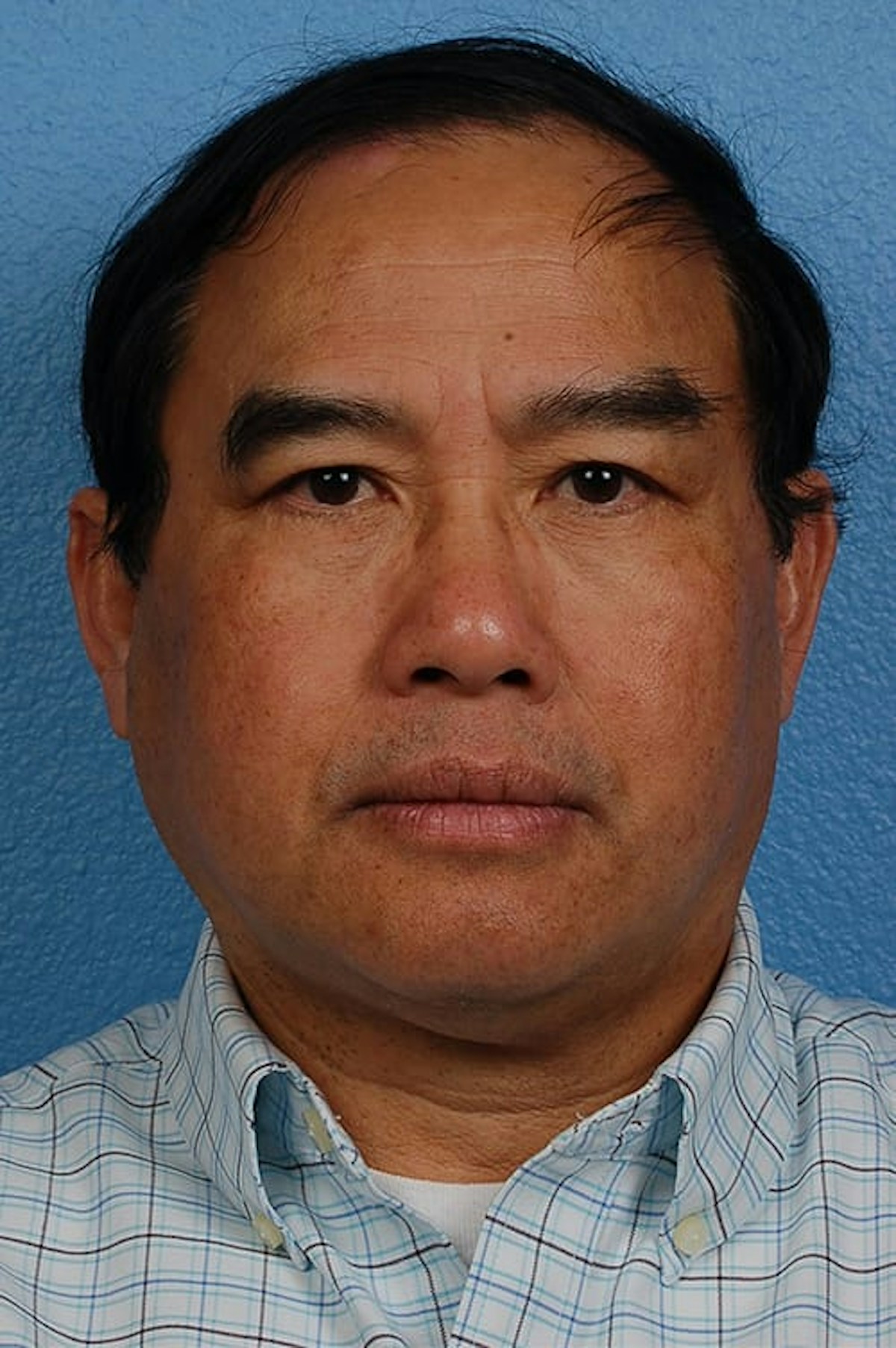 Blepharoplasty Before & After Gallery - Patient 232957 - Image 2