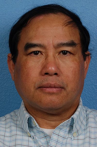Blepharoplasty Before & After Gallery - Patient 232957 - Image 2