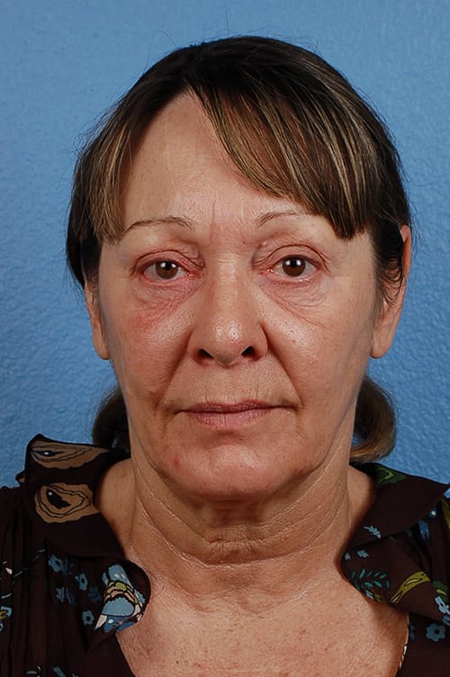 Hidden Patients Before & After Gallery - Patient 157868 - Image 1