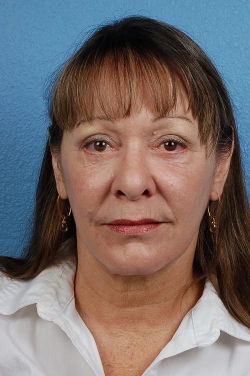 Hidden Patients Before & After Gallery - Patient 157868 - Image 2