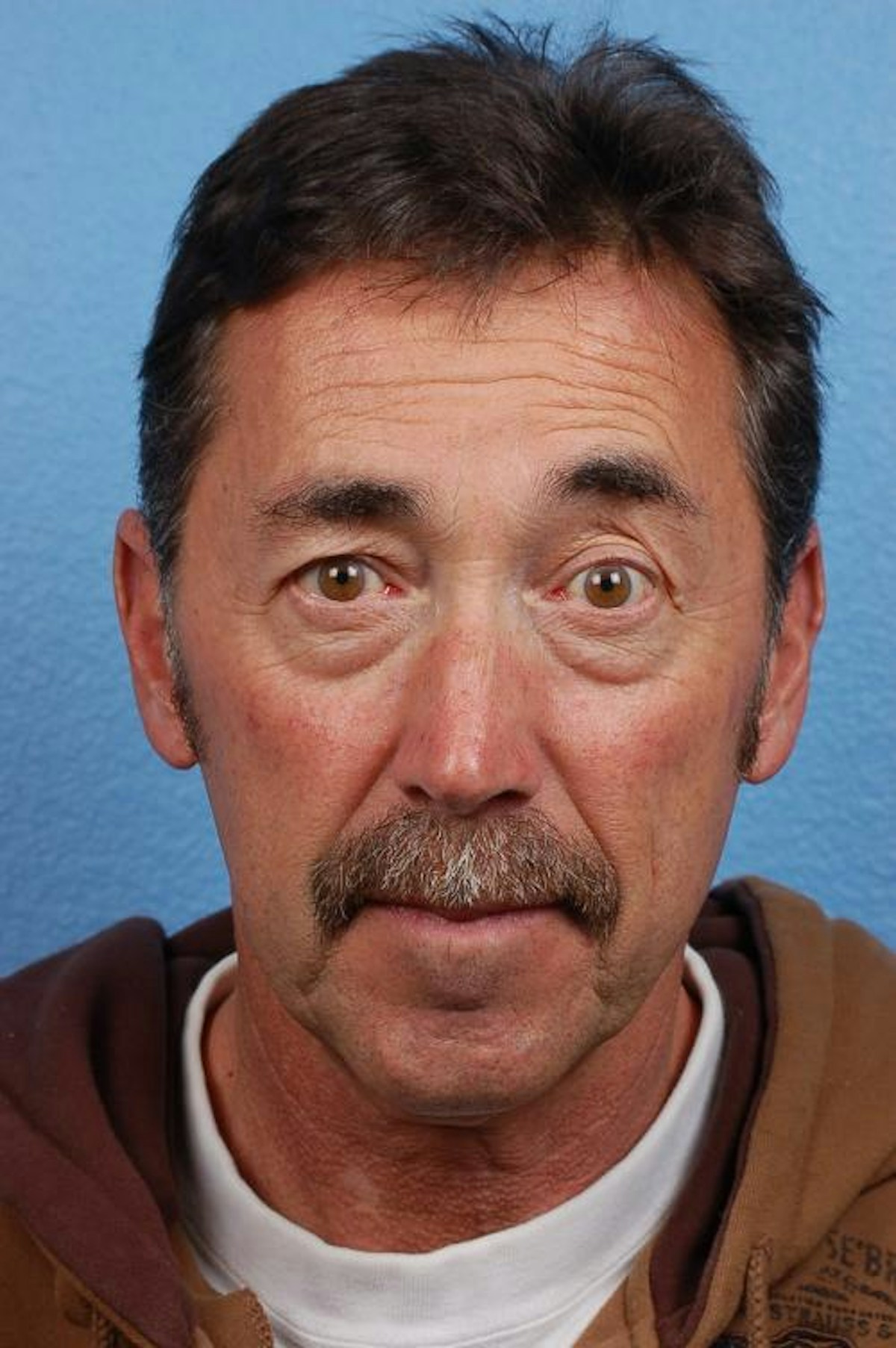Facelift Before & After Gallery - Patient 559090 - Image 1