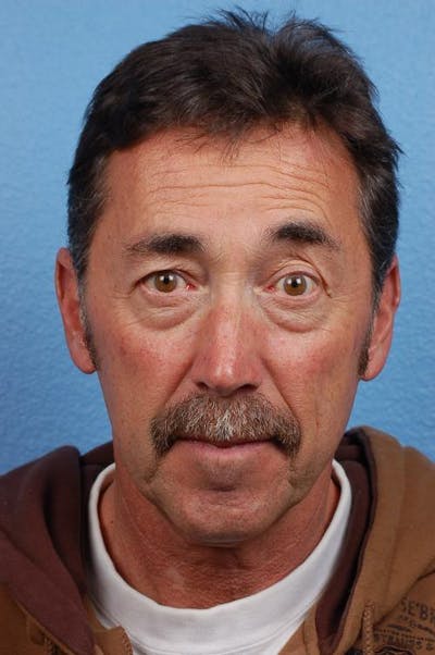 Blepharoplasty Before & After Gallery - Patient 289939 - Image 1