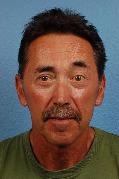 Blepharoplasty Before & After Gallery - Patient 289939 - Image 2