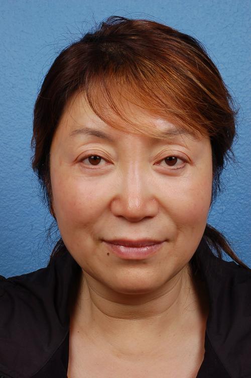 Hidden Patients Before & After Gallery - Patient 418792 - Image 1