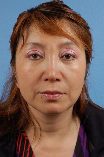 Hidden Patients Before & After Gallery - Patient 418792 - Image 2