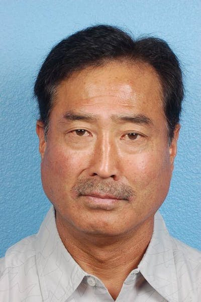 Blepharoplasty Before & After Gallery - Patient 481320 - Image 1