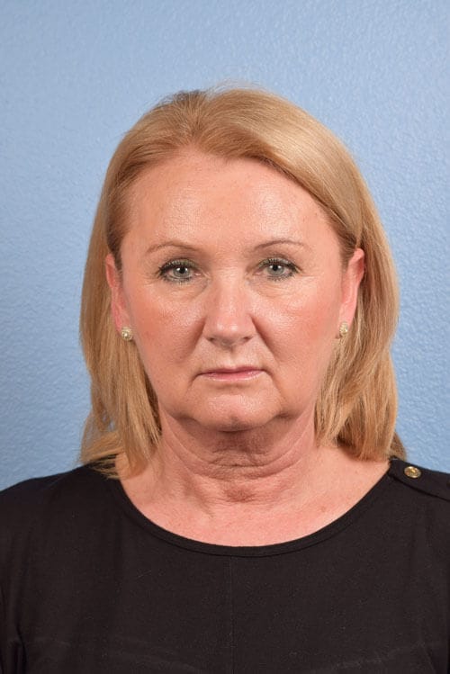 Neck Lift Before & After Gallery - Patient 207141 - Image 1