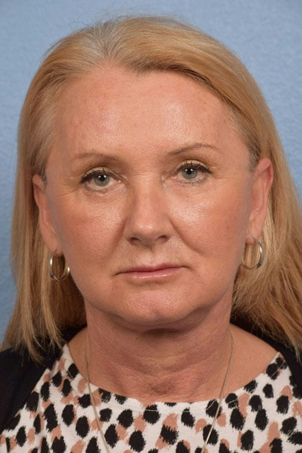 Neck Lift Before & After Gallery - Patient 207141 - Image 2