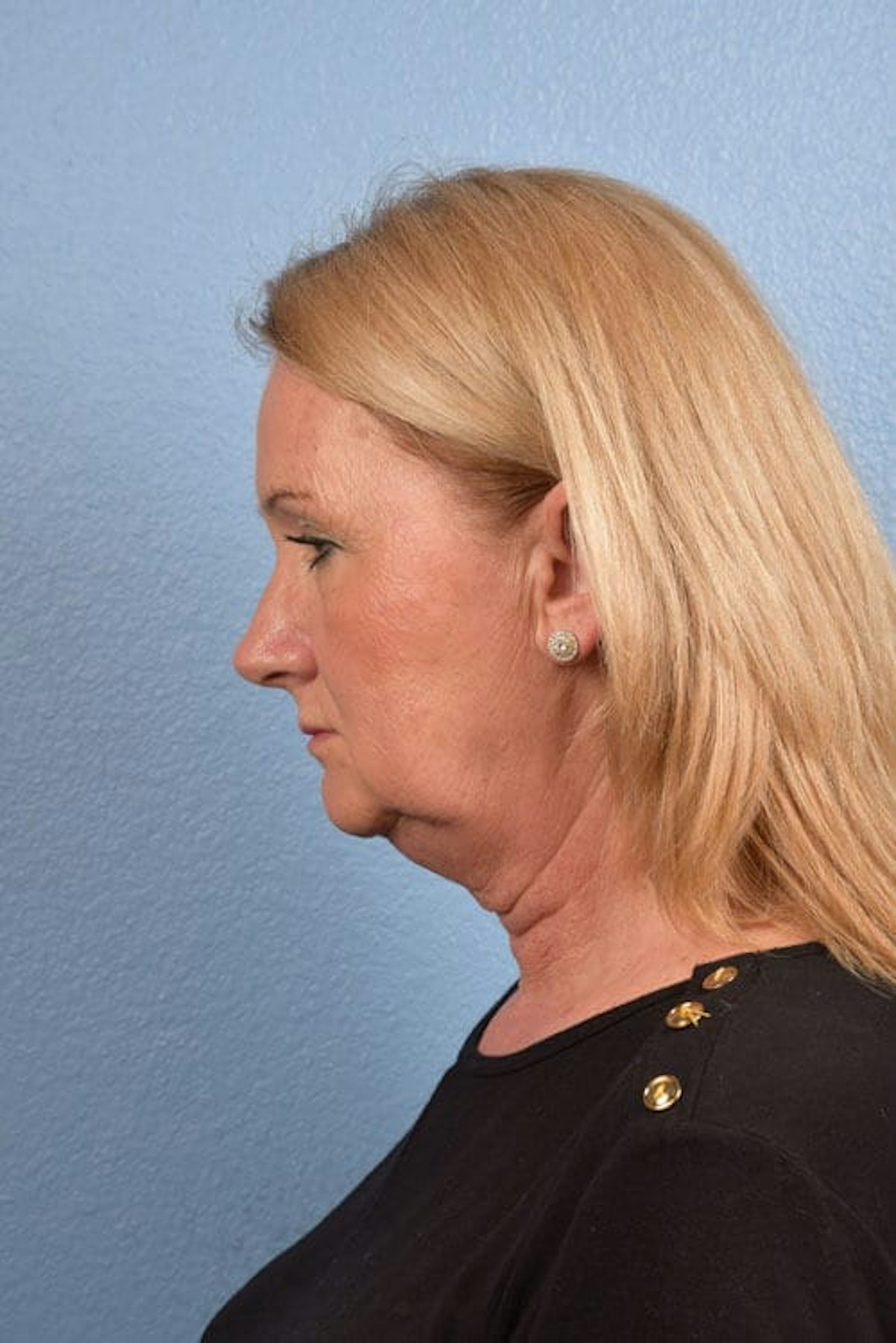 Neck Lift Before & After Gallery - Patient 207141 - Image 3