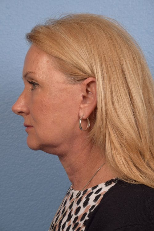 Neck Lift Before & After Gallery - Patient 207141 - Image 4